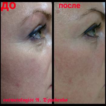 Лицо на выход Hyamatrix
Неинвазивная биоревитализация 