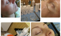 Карбокситерапия Косметолог-эстетист Ирина Валерьевна Одесса