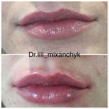 Увеличение губ