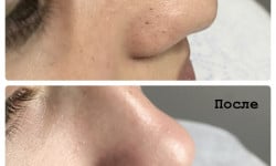 Чистка лица ZO Obagi, Hydropeptide Косметолог Юлия Манаева Херсон