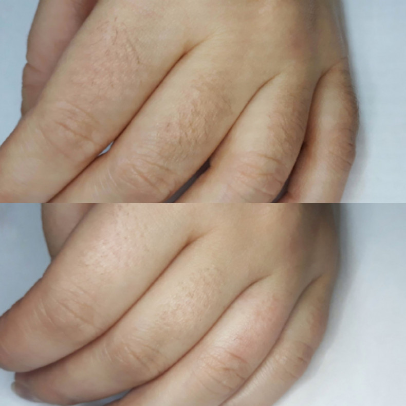 Лазерное удаление нежелательных волос. Александритовый лазер, фото -  Ксения Стельмах