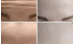 Ботулинотерапия, ботокс, ботулакс, диспорт, botox, неронокс, нейронокс Косметолог Ирина Васильевна Одесса