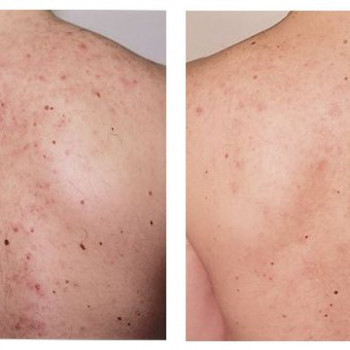 Чистка спины
                    Косметолог Ирина Васильевна Одесса