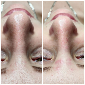 Механическая, комбинированная чистка лица
                    Косметолог Алина Диброва Запорожье