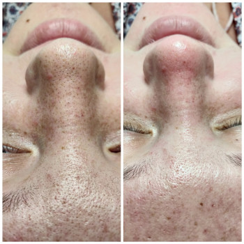 Механическая, комбинированная чистка лица
                    Косметолог Алина Диброва Запорожье