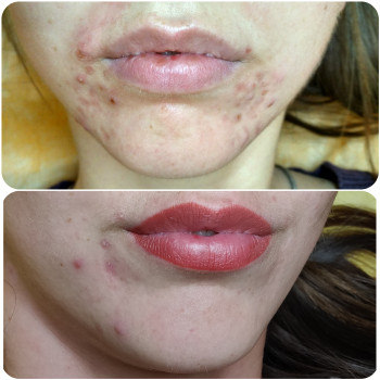 Лечение акне
                    Косметолог Алина Диброва Запоріжжя