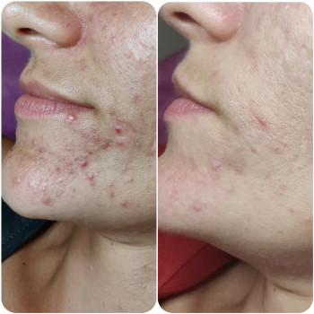 Лечение акне
                    Косметолог Алина Диброва Запоріжжя