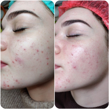 Лечение акне
                    Косметолог Алина Диброва Запоріжжя