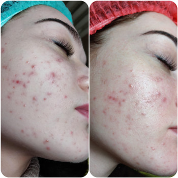 Лечение акне
                    Косметолог Алина Диброва Запоріжжя