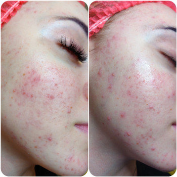 Лечение акне
                    Косметолог Алина Диброва Запоріжжя