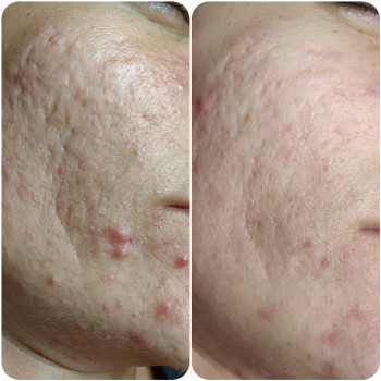 Лечение акне
                    Косметолог Алина Диброва Запоріжжя