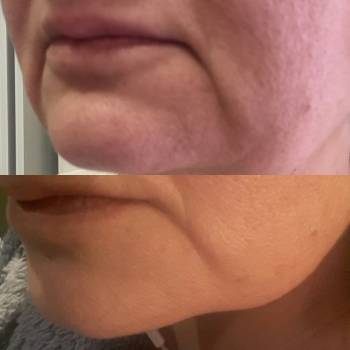 Липолитик
До и после