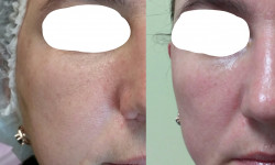 Контурная пластика Лікар-косметолог Майя Київ