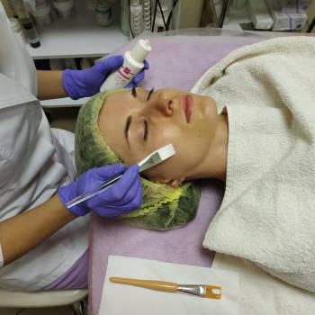 Химический пилинг