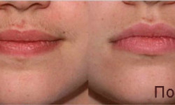 Лазерная эпиляция Light Sheer Нігтьова студія Муза Київ