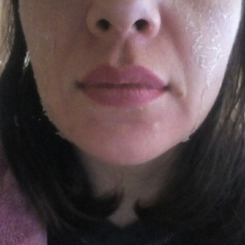 Пилинг Джесснера-шелушение