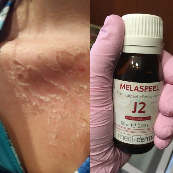 Пилинг Джесснера