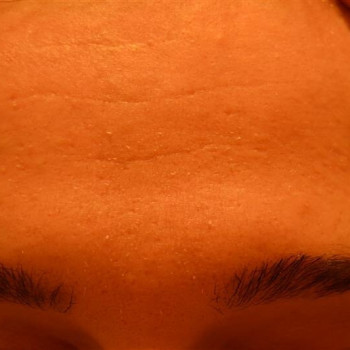 Салициловый пилинг