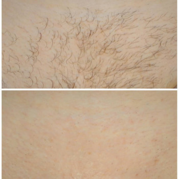 Шугаринг бікіні повністю.
Тривалість 30-45хв.