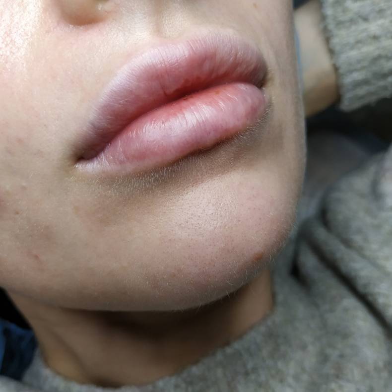 Збільшення губ препаратом juvederm, фото - Косметолог Олена Лисак