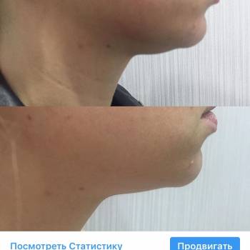 Липолитик 