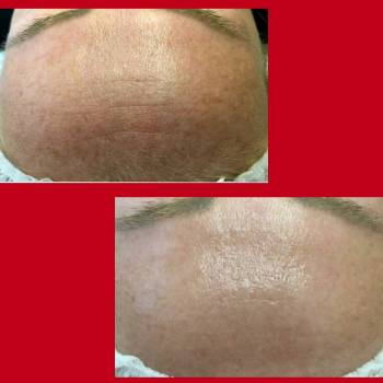 Биоревитализирующий пилинг PRX-t33