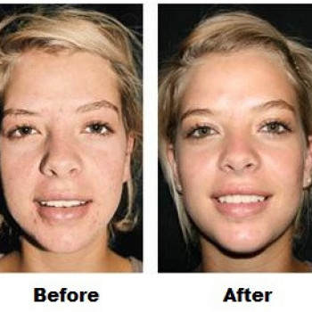 гликолевый пилинг до и после