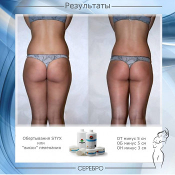 Виски пеленание STYX
                    Косметологический центр Серебро Одесса