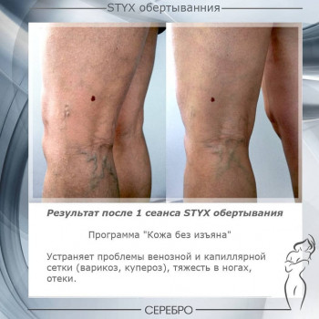 Виски пеленание STYX
                    Косметологический центр Серебро Одесса