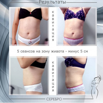 Кавитация (в зависимости от зоны)
                    Косметологический центр Серебро Одесса