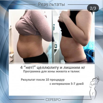Кавитация (в зависимости от зоны)
                    Косметологический центр Серебро Одесса