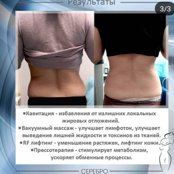 Кавитация (в зависимости от зоны)
                    Косметологический центр Серебро Одесса