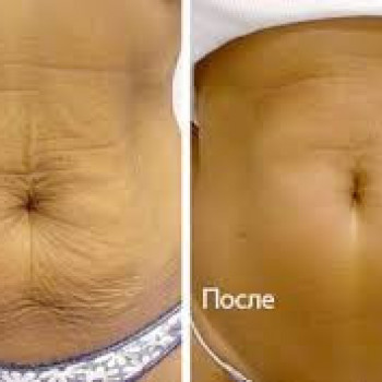 дермаштамп до и после