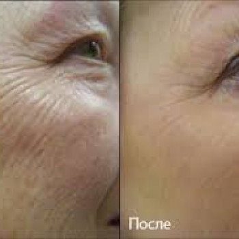 дермаштамп до и после