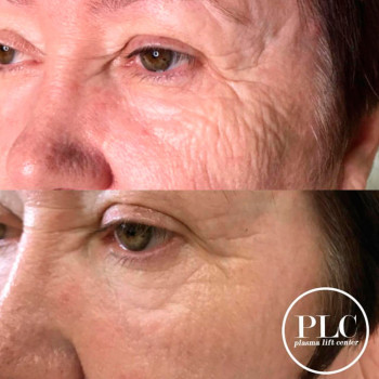 плазменный коагулятор до и после