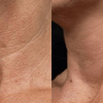 плазменныйй коагулятор до и после