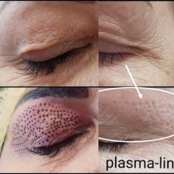 плазменный коагулятор до и после