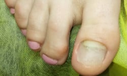 Протезирование ногтей Подолог Ольга Одесса