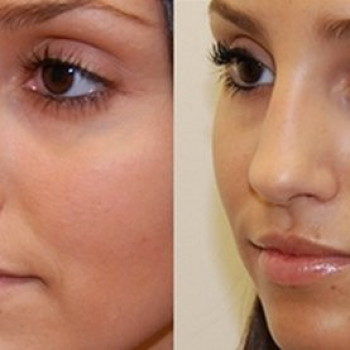 Ринопластика без операции
                    Косметологический центр Надія Кривой Рог