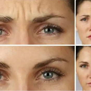 Ботулинотерапия
                    Косметологический центр Надия Кривой Рог