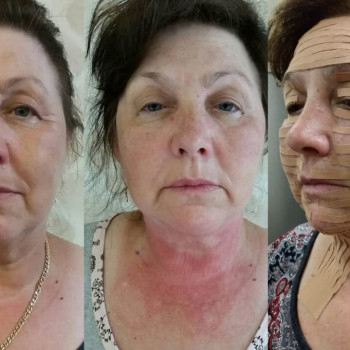 тейпирование до и после