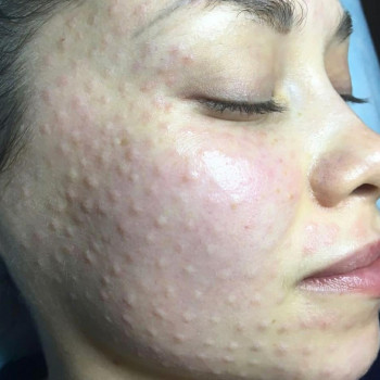 Биоревитализация 