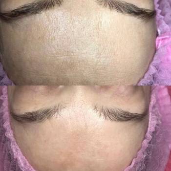 Лечение пигментных пятен