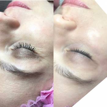 Лечение пигментных пятен