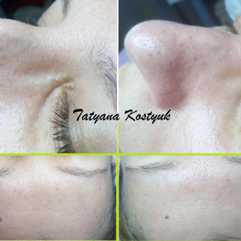 комбинированная чистка лица (ультразвук+мануально)