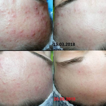 Чистка комбинированная лица, спины, декольте
                    Салон красоты BeautySkin Киев