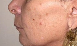 Нитевой лифтинг лица, тела Пластичний хірург Александр Херсон