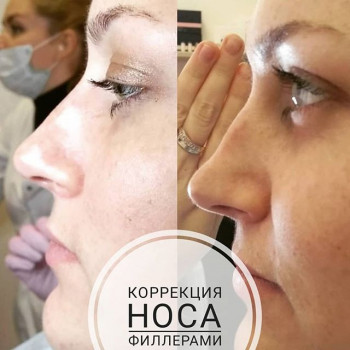 Ринопластика без операции
                    Косметологический центр Надія Кривой Рог