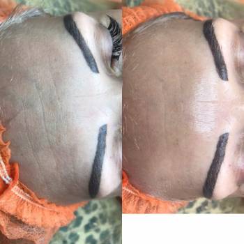 Результат після однієї процедури пілінгу