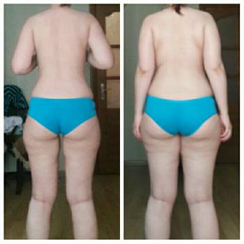 Результат після курсу процедур вакумно-роликового масажу